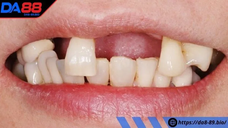Ý nghĩa giấc mơ thấy rụng răng chi tiết
